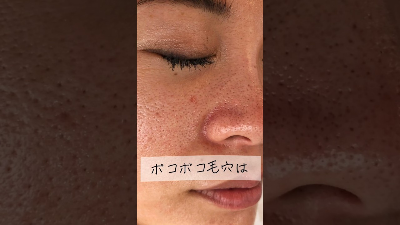 【開き毛穴・ボコボコ毛穴】は治らないってまだ言ってるの⁉️