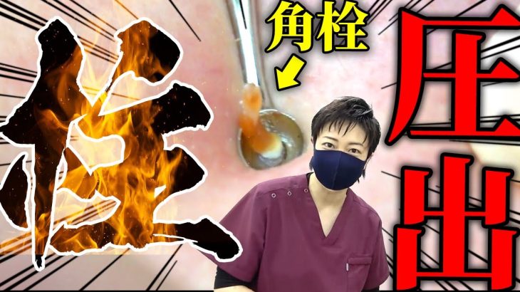 【角栓の柱】特大・大量の角栓を圧出します！