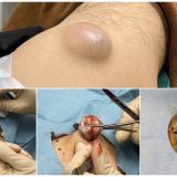 ふるばやし形成外科粉瘤クリニック　ブログでも詳しく解説してます。　東京新宿院　大腿部の粉瘤　くりぬき法　大阪梅田形成外科クリニック