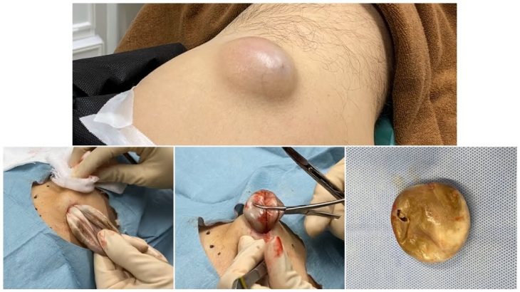 ふるばやし形成外科粉瘤クリニック　ブログでも詳しく解説してます。　東京新宿院　大腿部の粉瘤　くりぬき法　大阪梅田形成外科クリニック