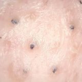 031 角栓毛との闘い（高勝率）  Dr. tweezers 高倍率毛抜き Pull out