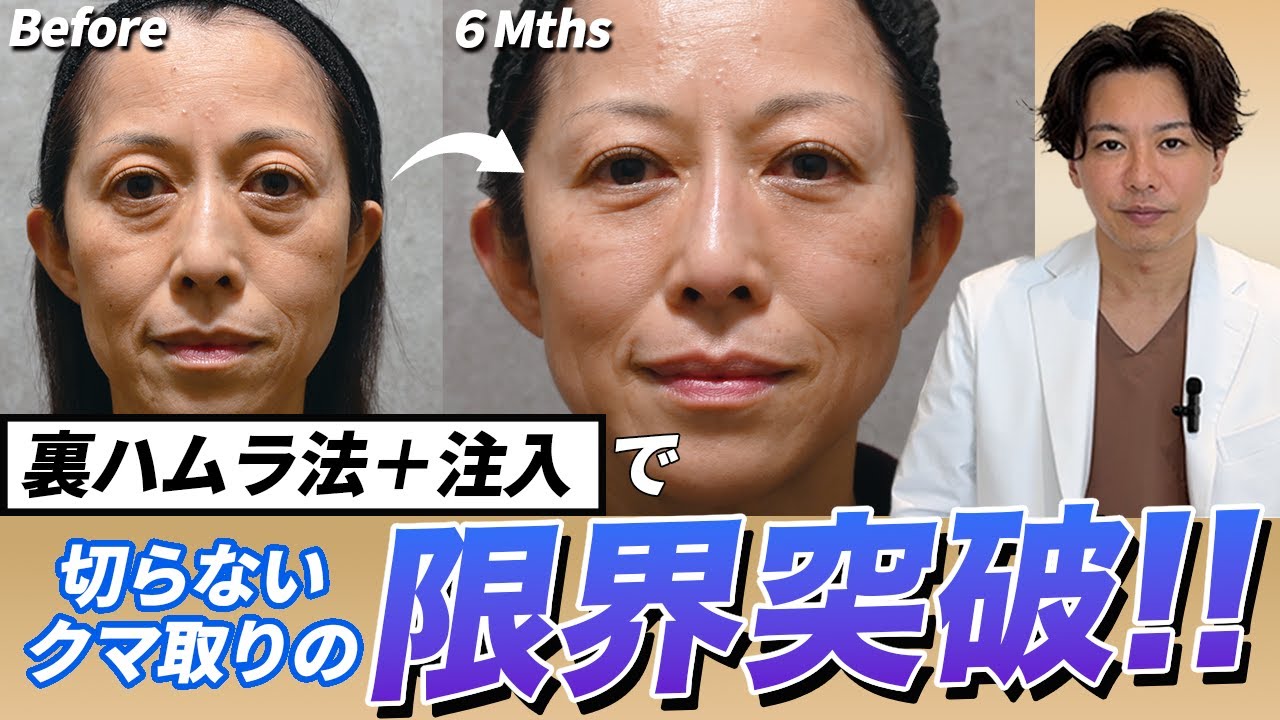 【40代以上推奨動画】皮膚切開のクマ取りにちょっと待った！裏ハムラ法＋注入という選択肢