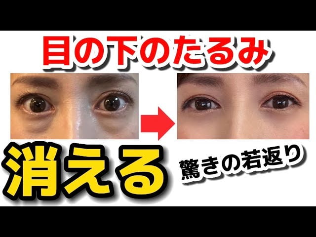 目の下のたるみを解消する方法【根本から改善】40代50代