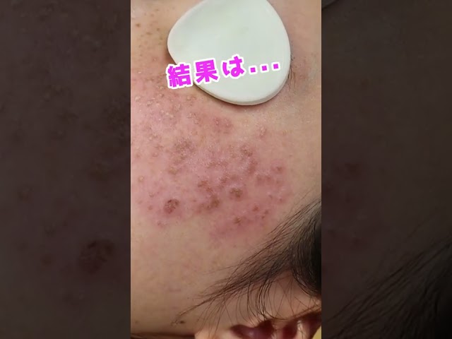 【しみ・そばかす】美容皮膚科なら１回でどこまで綺麗になる？