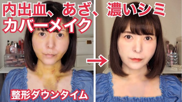 【ダウンタイムメイク】シミ、内出血、あざをメイクで隠す。整形がバレない方法。シミカバーメイク