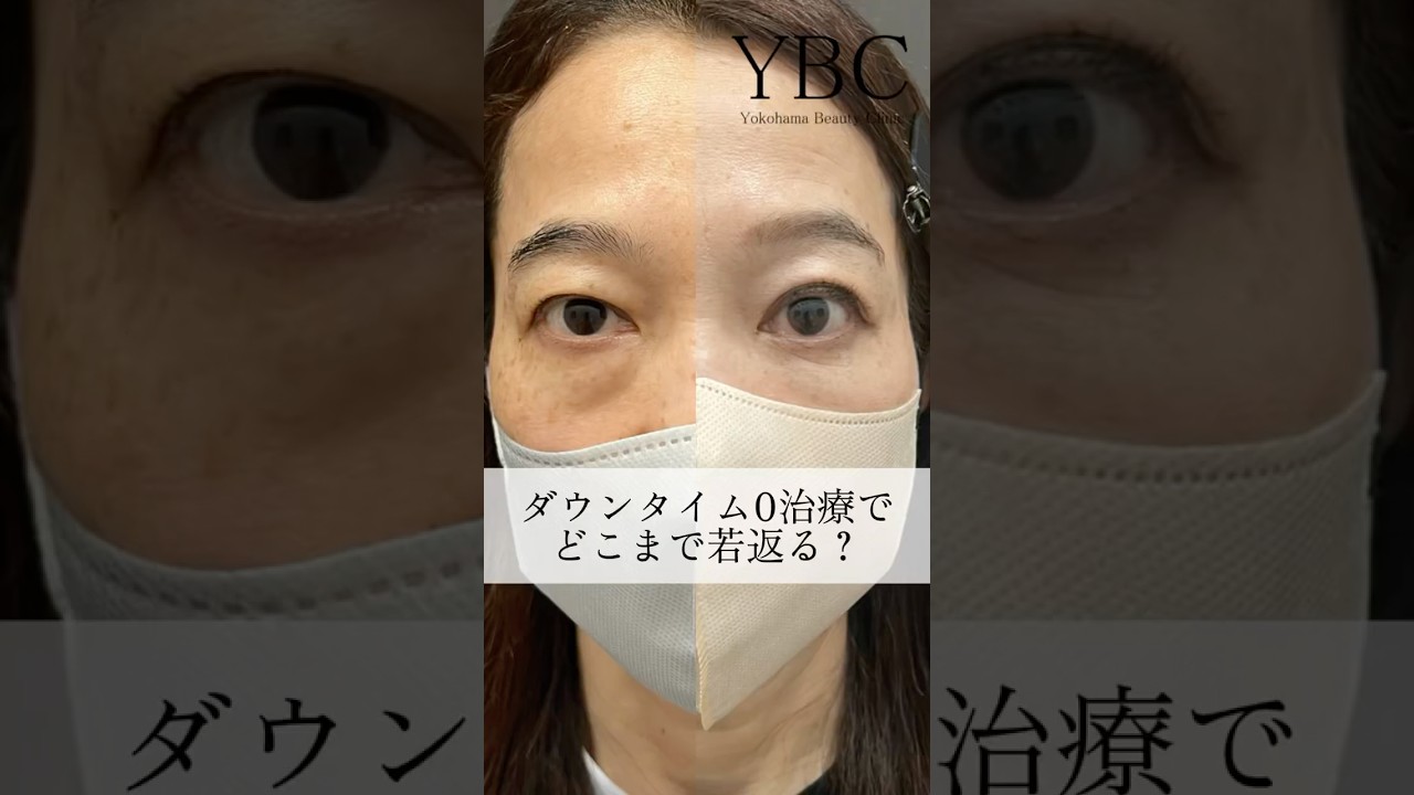 ダウンタイム0の施術でどこまで若返る！？#クマ取り #目の下のクマ #目の下のたるみ取り #美容整形 #美容 #若返り #老化防止 #健康 #ybc横浜美容外科 #イソセン