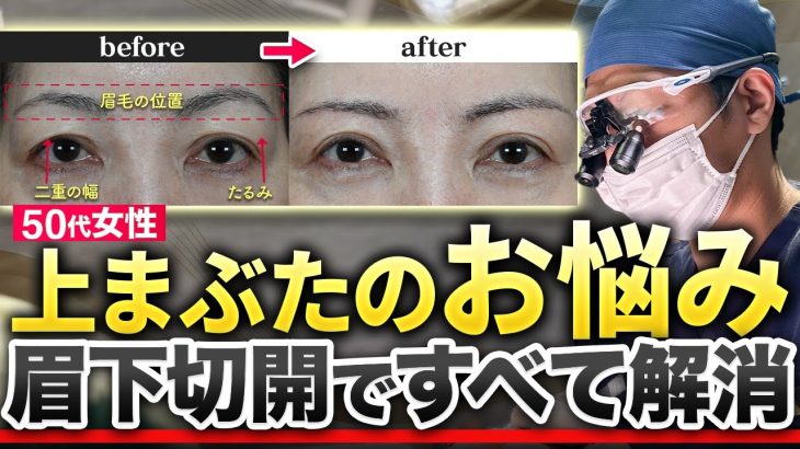 【症例解説】上まぶたのたるみを眉下切開で解消！術前〜術後まで全て見せます！