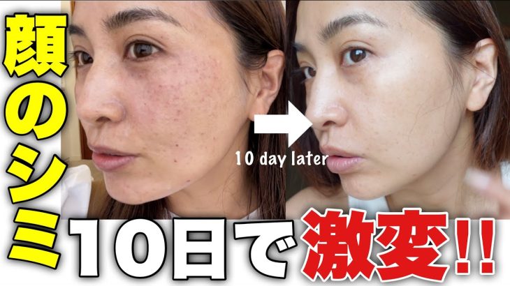 【シミ治療】43歳フォトフェイシャルで美肌✨ 10日間でここまで変わった経過を見せます。【美容医療】