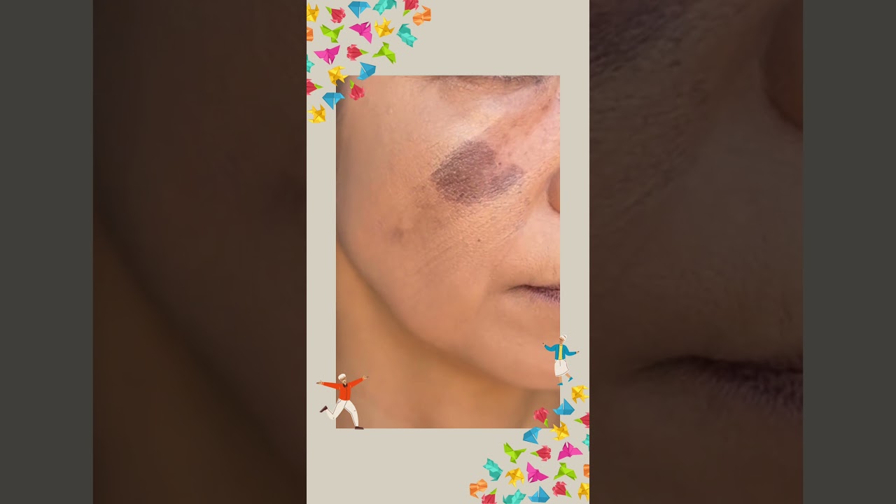 クッションファンデで濃いシミをきっちりカバーするやり方を撮影してきたよー。画像修正なし、加工なし。#shorts  #シミ #コンシーラー  #メイク方法  #クッションファンデーション  #シミ消し