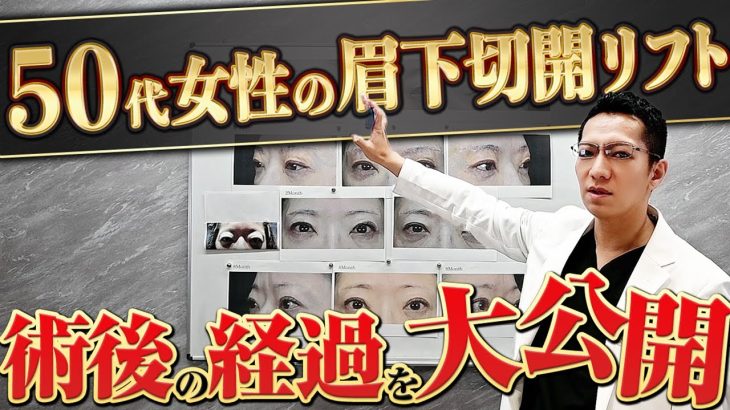 【症例解説】50代女性の眉下切開の傷跡とダウンタイムについて解説します！