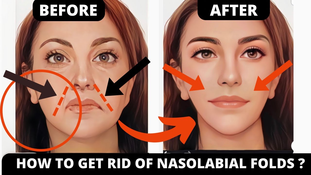 Face Lifting Yoga for Laugh Lines & Nasolabial Folds! Lift Smile Lines in 14 days!
