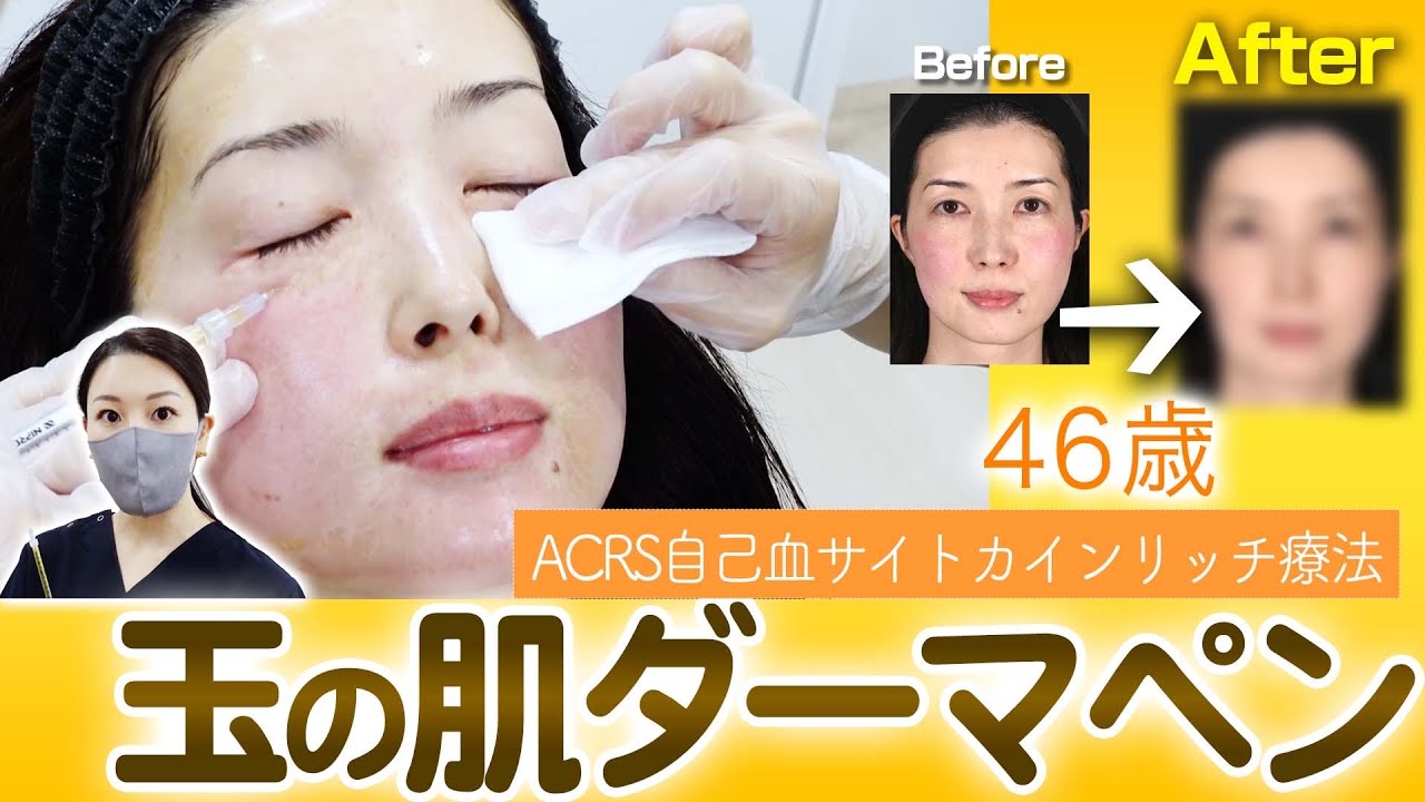 【小ジワ・たるみ・毛穴が気になる46歳】”玉の肌ダーマペン”をうけていただきました。