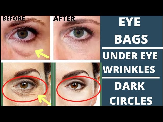 🛑 Face Yoga for Puffy Eyes & Dark Circles: Lift & Smooth Eye Wrinkles Fast!