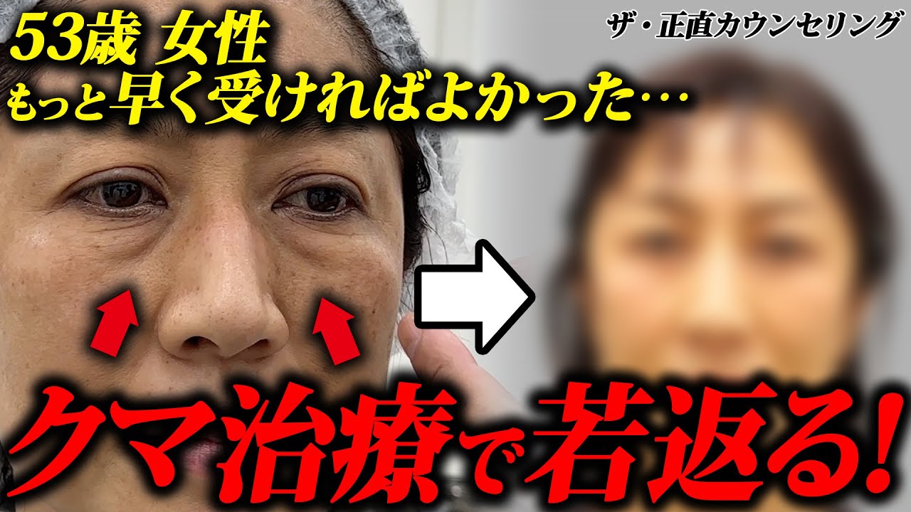 【クマ取りで若返り】53歳女性・初めて美容治療に挑戦！自然な若返りに感動しました