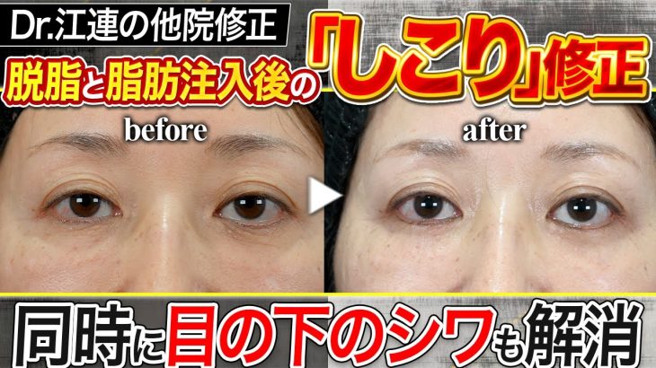 【修正手術】しこり…残ってますよ？修正と同時に目の下のシワまで除去する【脱脂/クマ取り/脂肪注入】