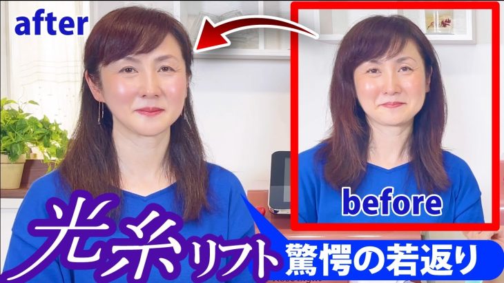 【最先端美容】知ってる？驚愕の若返りで話題沸騰の光糸リフト