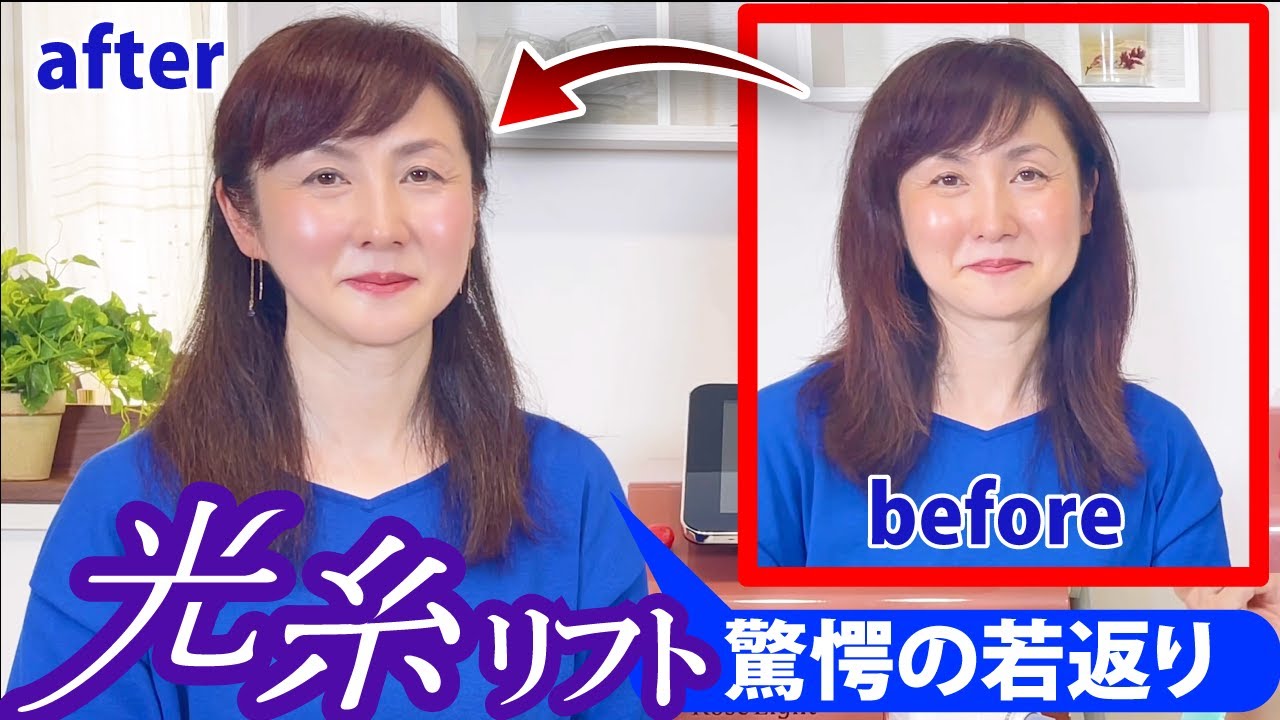 【最先端美容】知ってる？驚愕の若返りで話題沸騰の光糸リフト