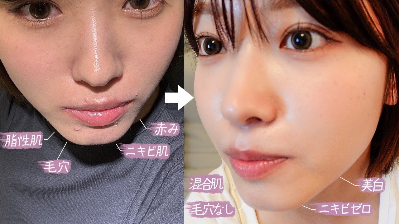 ニキビ肌からトラブルなしの肌になった私の肌管理について話します🩵（ スキンケア 美肌施術 肌質改善 垢抜け ）