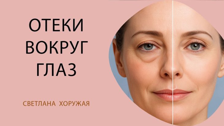 Отеки вокруг глаз. Лимфодренажный массаж