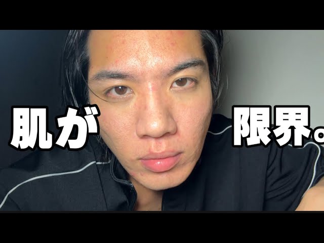 ニキビの限界突破スキンケアを見せる。イライラが止まらない。